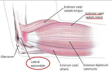 lateral epicondylitis Extensor carpi radialis brevis(ecrb) tendon + repetitive microtrauma Kraushaar BS, Tendinosis of the