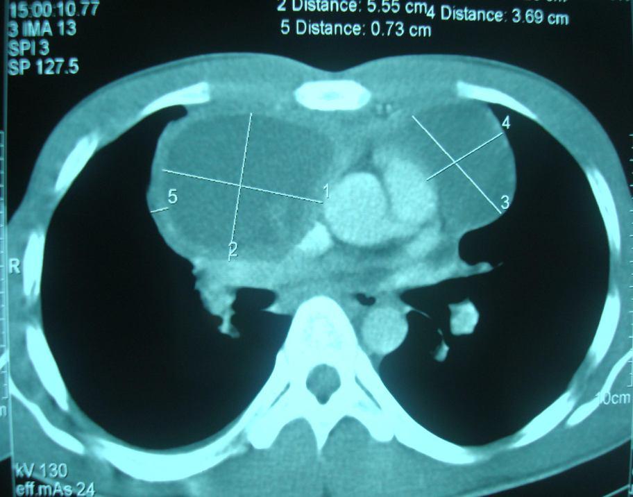 Hình 1: Trên phim X-quang ngực thường quy nhìn thấy u lớn, lấn sang khoang màng phổi P, nằm 2 