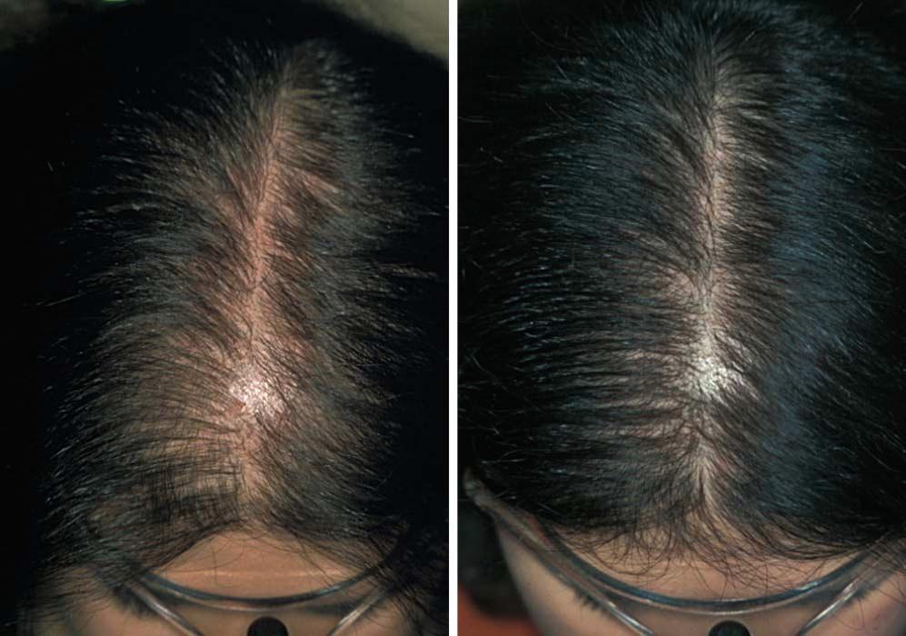 A Figure 1. Christmas tree pattern of hair loss shows moderate improvement compared with baseline (A) after 12 months of oral finasteride treatment (). in women of childbearing potential.