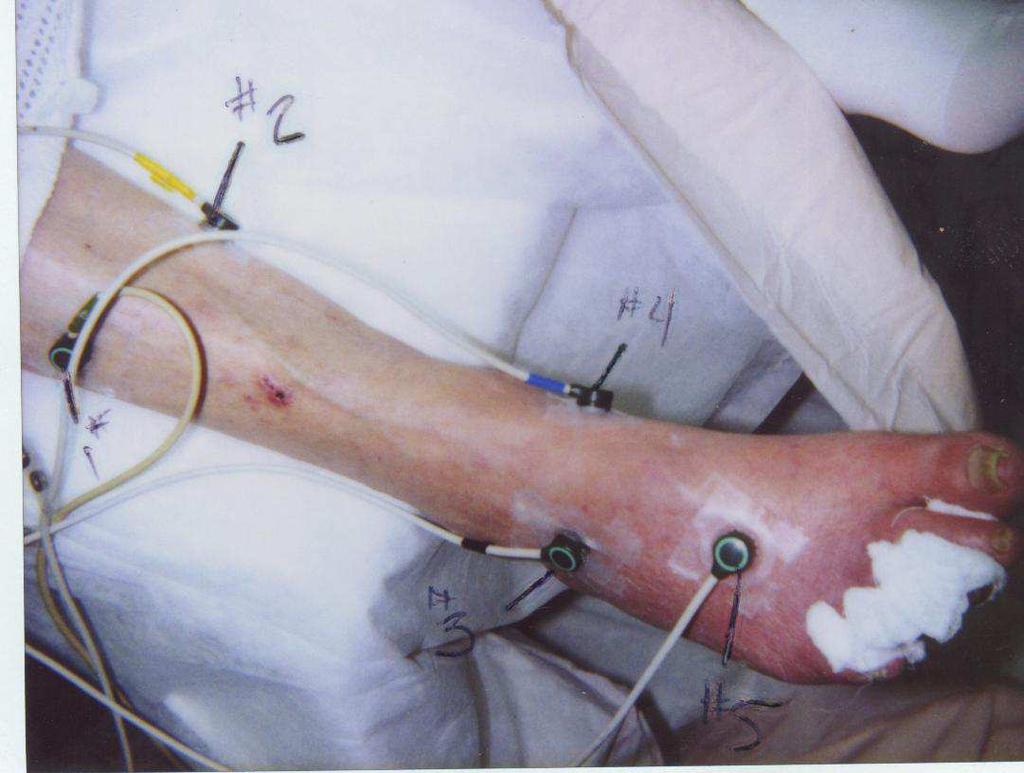 Transcutaneous oximetry TcpO2 < 40 mm Hg : Hypoxic wound THEN