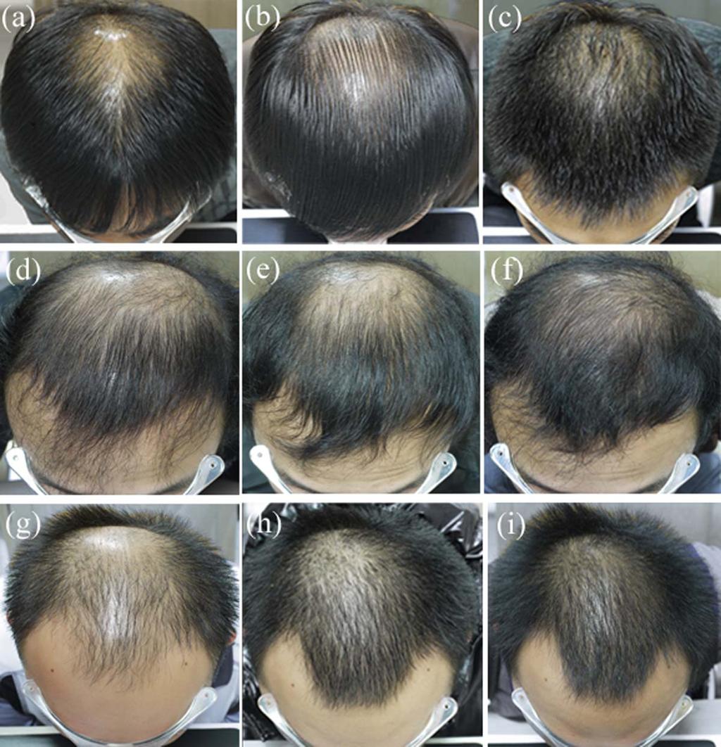 Hu et al. FIG. 2. (a) (c). A 23-year-old man treated with finasteride at 1mg/day.