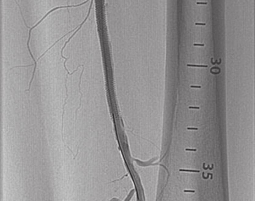 SFA lesion 15 cm long with a 6 cm occlusion