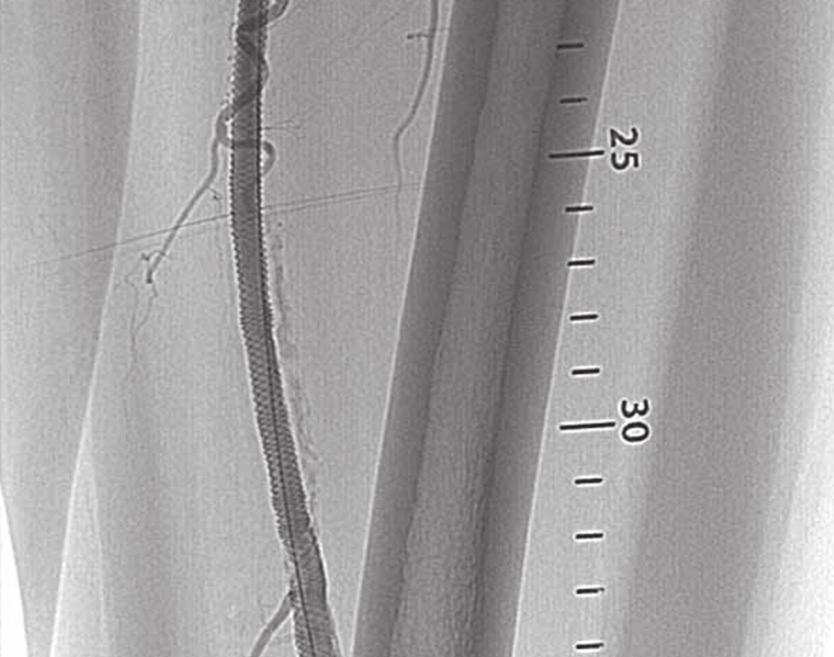 GmbH. Case 1: Pre-dilatation SFA lesion 15 cm long with a 12 cm