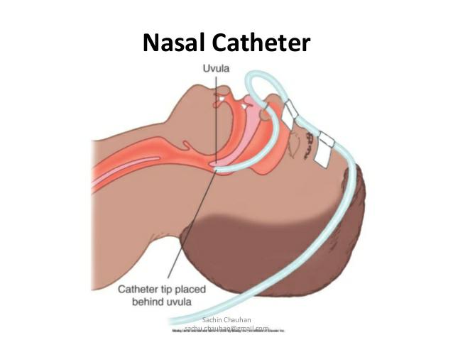 2. Nasal Catheter :- Nasal Catheter is most common method which used in Hospital. Change the Position after every 8 hours into opposite nostrils.