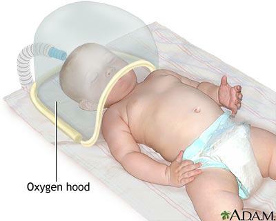 Oxygen Hood :- A Plastic Dome that Inclose Infant Head Flow