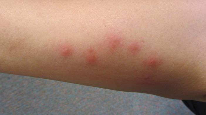 Figure 5. Bed bug bites, clustered (Photo by Xing Ping Hu) Decrease clutter around the bed.