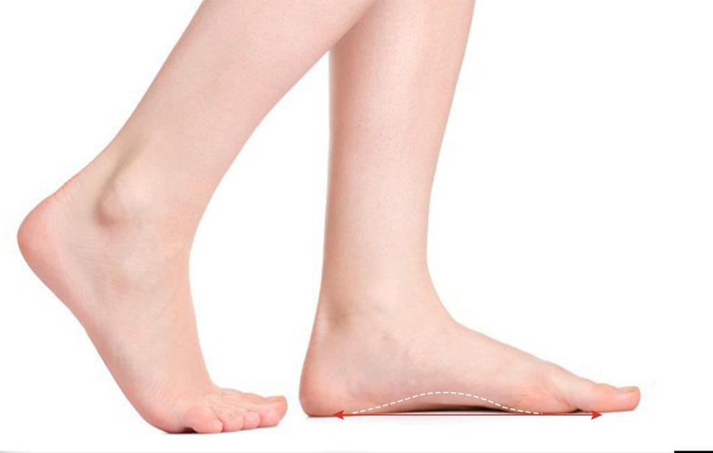 Symptoms and Causes of Flat Feet Symptoms Pain in foot, leg, and knee. Outward pointing feet. Inward or tilted walking style.