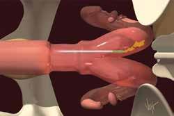 If you do not feel the gristly sensation of the cervix on the gun, you are still in step one of the process.