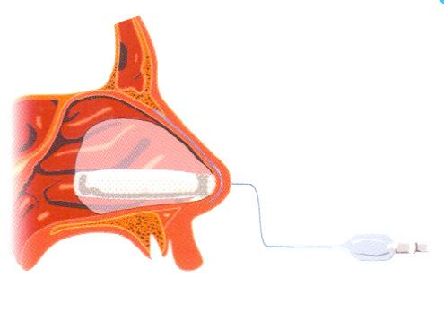 4. Insert the RR device into the nasal cavity along the septal floor and parallel to the hard palate, until the plastic proximal fabric ring is well within the nares, (in order to allow the