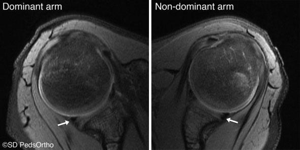 4 Pennock et al The Orthopaedic Journal of Sports Medicine Figure 3. Axial proton density fat-suppressed image demonstrating a posterior labral tear.