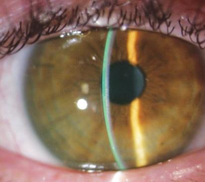 sagittal depth Ideal clearance OCT Image White light Next Step Limbal Zone: Observe Limbal Clearance If