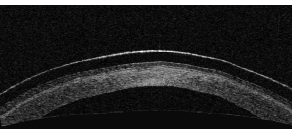 Apical clearance may be adjusted by increasing or decreasing the sagittal depth of the lens.