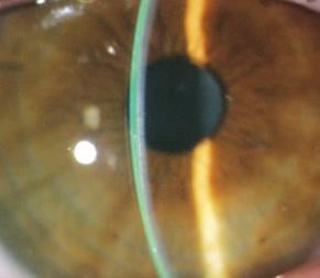 A deeper sagittal depth may be necessary in eyes that are prone to progressive ectasia. Insufficient Clearance Lens 0.