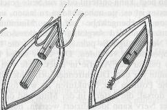 Discussion There are different methods for cutting the nerve.. Present common practice is to remove a piece of the nerve and stitch the perineurium, as shown in Adams lameness in horses (Fig.10).