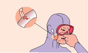 Middle Ear Squeezes Occurs when the air or water pressure in your outer ear is greater than the air pressure in your middle ear.