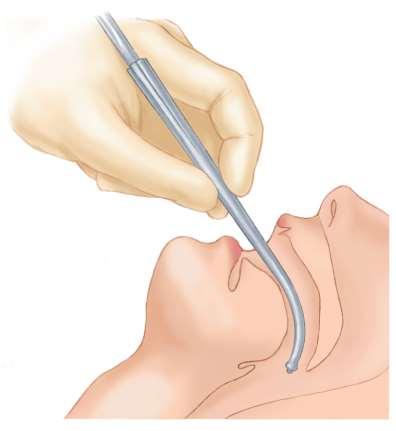 Rigid Pharyngeal Tip Place the convex side of the rigid tip