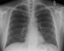 Over exposure to silica dust can cause a lung disease known as silicosis and lung cancer These diseases have no cure Normal x-ray Symptoms of silicosis include chronic dry cough and shortness of