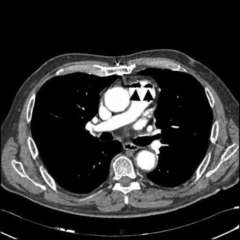 CECT (axial view) shows, in the main pulmonary artery, two gas bubbles of