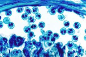 Melanisation of the macrophages (MM).