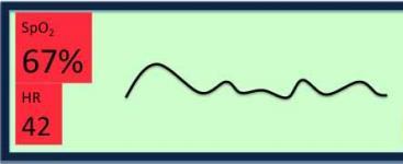 Plethysmograph Measures pulsatile flow Good pleth vs bad pleth