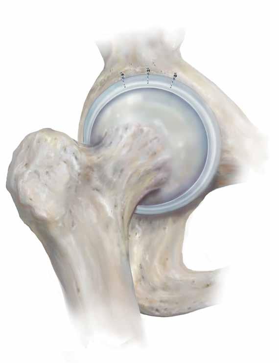 CinchLock SS (Sports Sheath) Knotless Labrum Restoration CinchLock SS Knotless Anatomic Labrum Restoration System is designed to