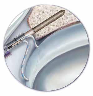 NOTE: A FlexStick Guide Wire can also be inserted through the anchor insertion portal into the bone hole to guide anchor insertion.