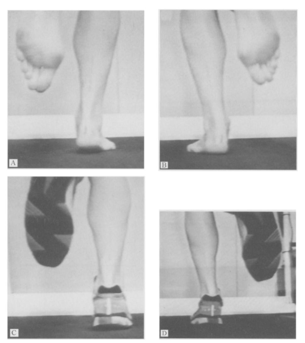 Barefoot, the heel contact phase may be reduced or absent (A) on the shorter side.