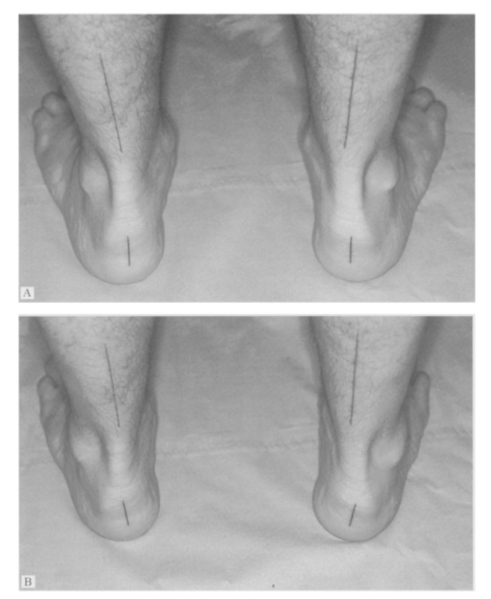 In this resting position, the angle the heel makes to the ground can be assessed and will be inverted, zero or everted. This is known as the relaxed calcaneal stance position (RCSP; A).