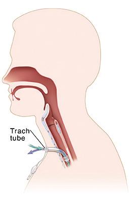 How does a tracheostomy (trach) work? What is a tracheostomy? A tracheostomy is an opening created for air to flow into the lungs.