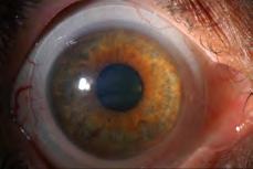 FITTING OXYGEN DEMANDS UNDER A SCLERAL