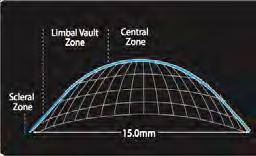 microns Central corneal vault under 200