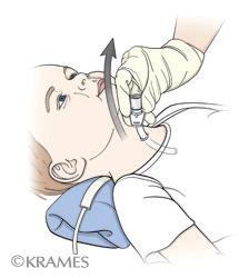 What do I need to know to change a trach?