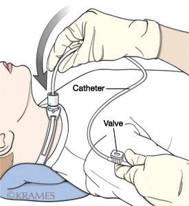 How do I suction the trach? It is not always possible to cough out secretions from a trach. In the hospital, suctioning is done by staff using a sterile technique.
