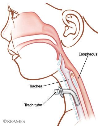 How does a tracheostomy (trach) work?