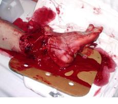 who is now confused or unconscious Blood spurting out of a wound Blood soaking the sheet or clothing Photo