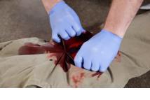cause blood to clot Open clothing around the wound Pack the wound Examples of hemostatic dressings include: -