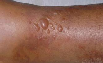 Total 641 (100.0) Primary septicemia skin lesions caused by Vibrio parahaemolyticus 25/8/2010 A 90-year-old male complaining of fever (39ºC) visited the doctor.