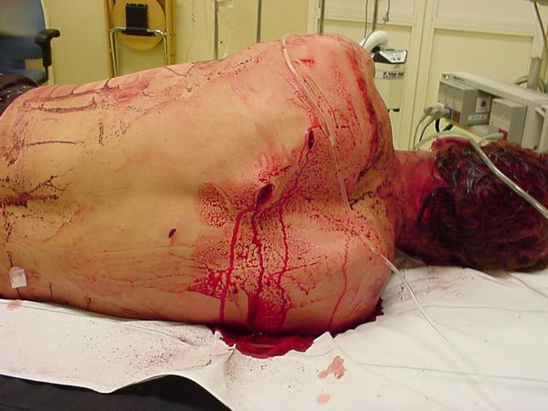 Signs and Symptoms of an Open Chest Wound If you are not sure if the wound has