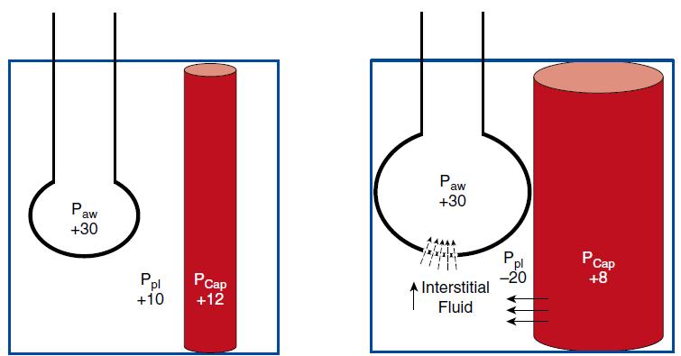 Increased Lung perfusion & distending pressures Mechanical Breath Spontaneous effort Transpulmonary pressure (Paw-Ppl = PL)= 30-10 =20