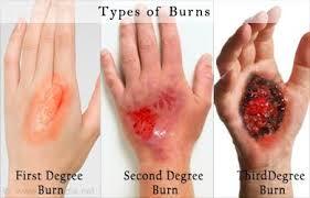 Burns are categorized in 3 degrees of severity: First degree