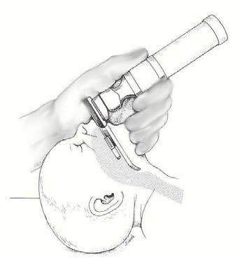 Preparing for intubation Estimated endotracheal size internal diameter can also be calculated as gestation age in weeks divided by 10 Estimated depth of insertion Rule of 6 Birth weight in kg + 6cm