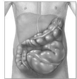 Task 4: Fernando s Abdominal Pain An enlarged large intestine is a complication of Chagas disease.