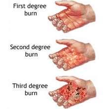 BURNS Determine the extent of damage to body tissues to distinguish a minor from a serious burn.