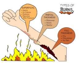 - Remove burning clothing if not stuck to skin and constrictive items (rings, bracelets, etc.). - Never break blisters. - If mild, protect burns with clean dry bandages or sterile gauzes.