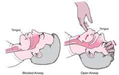 No breathing or gasping. E. 30 compressions (depth of compression - 2 inches / 5 cm) F. Open airway & give 2 breaths. 1.