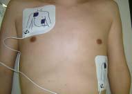 Special situations Put electrodes on victim s bare chest Water wipe