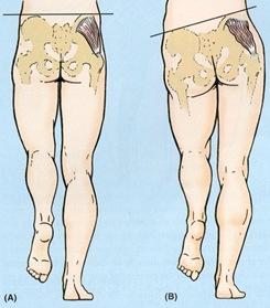 sources, including: Anterior hip impingement Iliopsoas bursa Hip stabilizer muscle weakness