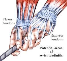 WRIST PAIN AND GOLF Wrist injuries are very common for golfers Repetitive strain on the tendons at the wrist joint can cause tendonitis/tendinopathy Extensor tendons on the top hand, or flexor