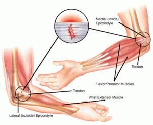 ELBOW PAIN AND GOLF Elbow tendonitis/tendinopathy is also very common and commonly related to repetitive strain Most commonly there is: medial elbow pain, often referred to as golfer s elbow and more