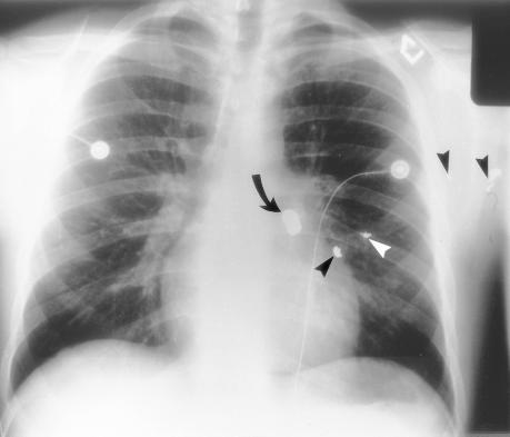 c. Figure 16. Gushot ijury i a youg ma who preseted to the emergecy departmet with a sigle bullet hole i the posterior thorax.